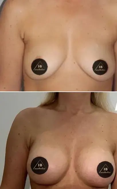 hakan-bulam-breast-augmentation-before-after