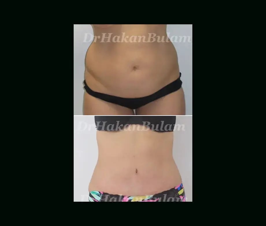 hakan-bulam-md-tummy-tuck-before-after-5-2