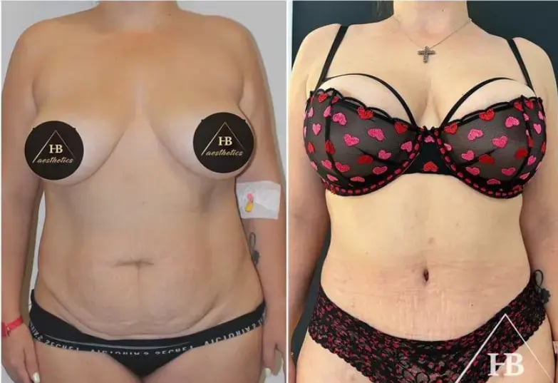 hakan-bulam-tummy-tuck-before-after-1