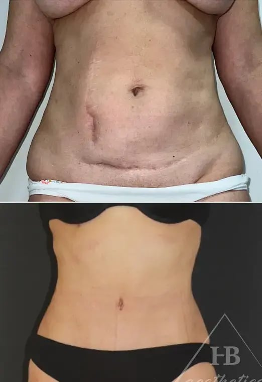 hakan-bulam-tummy-tuck-before-after