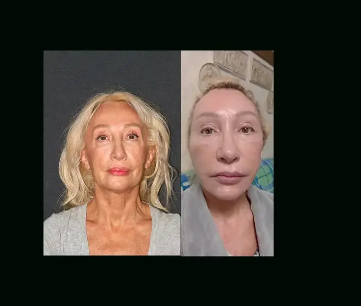 Helen, facelift with Dr. Mehmet Cömert