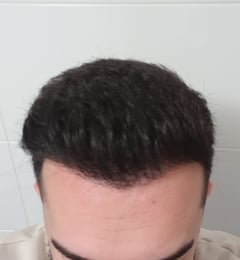 No Better Hair Transplant Results