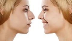 What Causes a Hook Nose?