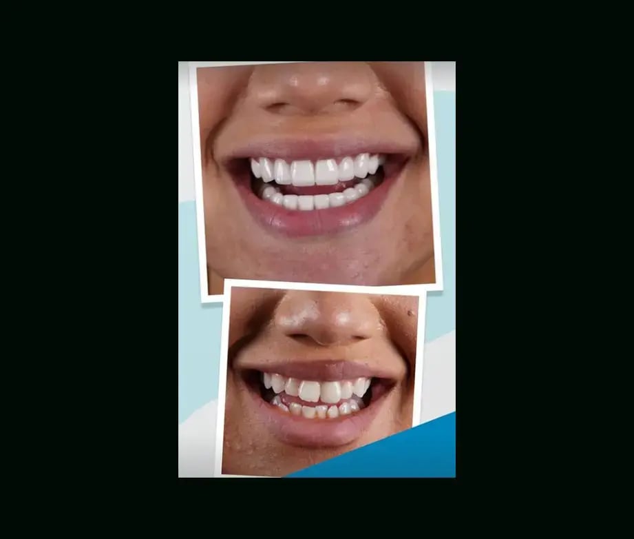 istadental-before-after-19