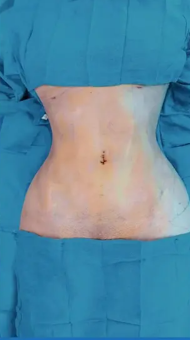 jale-ozdemir-liposuction-after-1