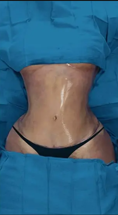 jale-ozdemir-liposuction-after-2