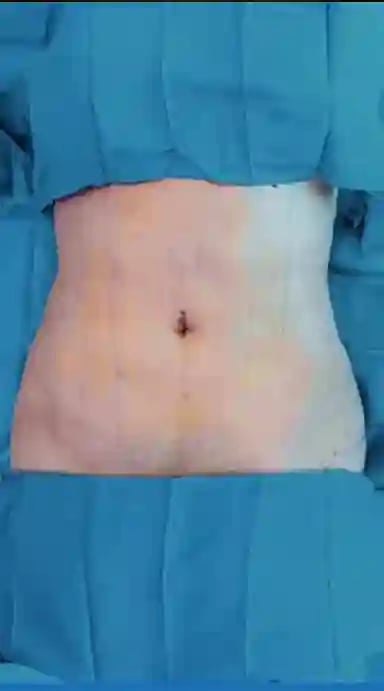 jale-ozdemir-liposuction-before-1