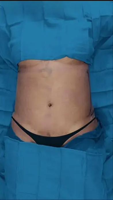 jale-ozeemir-liposuction-before-2