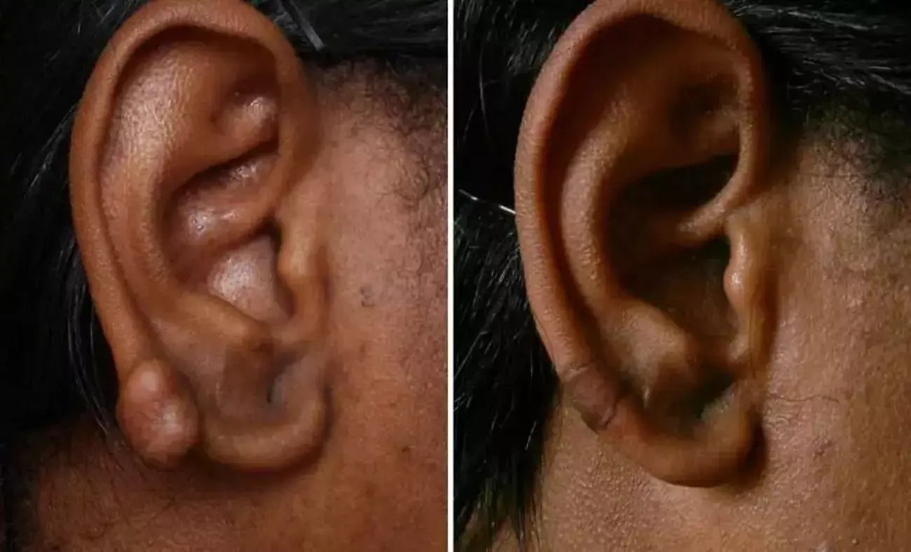 keloid-scar-before-after