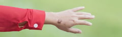 What is Keloid Scar?