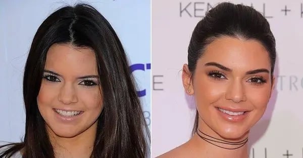 kendall-jenner-filler