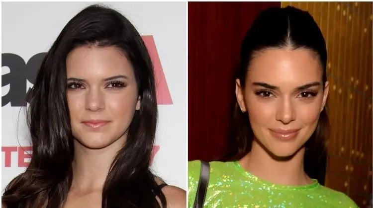 kendall-jenner-nasolabiel-filler