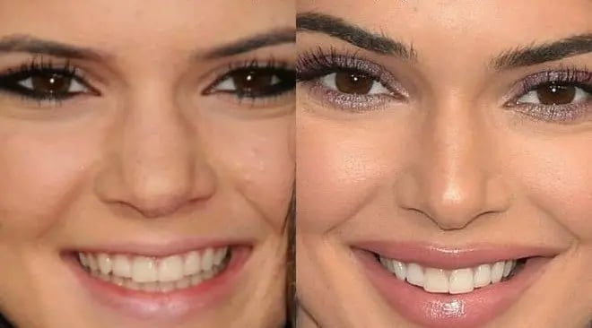 kendall_jenner-rhinoplasty