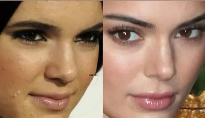 kendall_jenner- skin problems