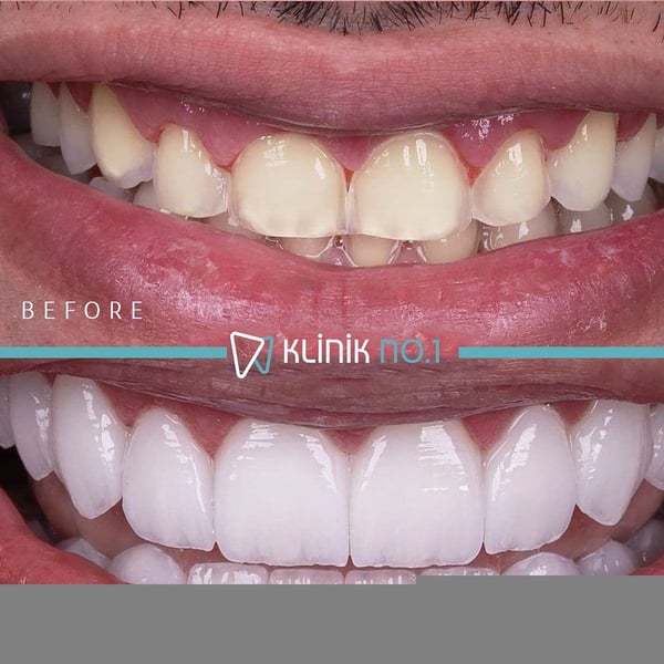 Before and after ceramic smile restoration, Klinik No.1