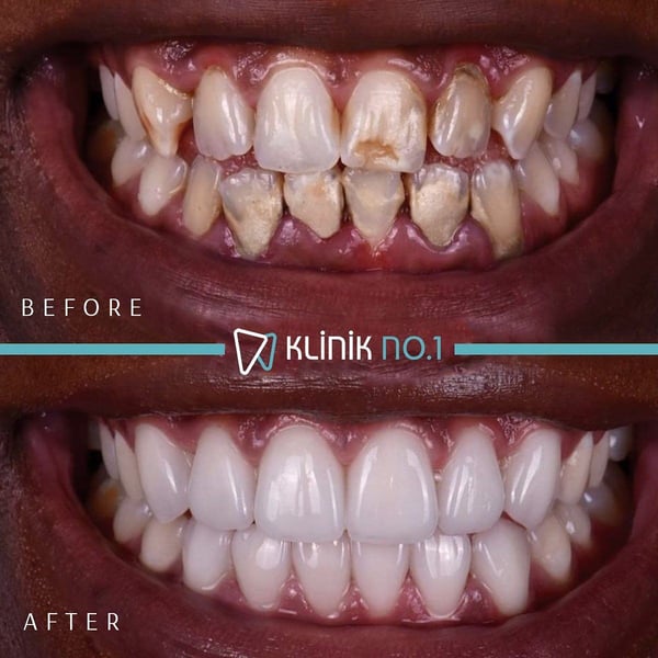 Before and after ceramic smile restoration, Klinik No.1