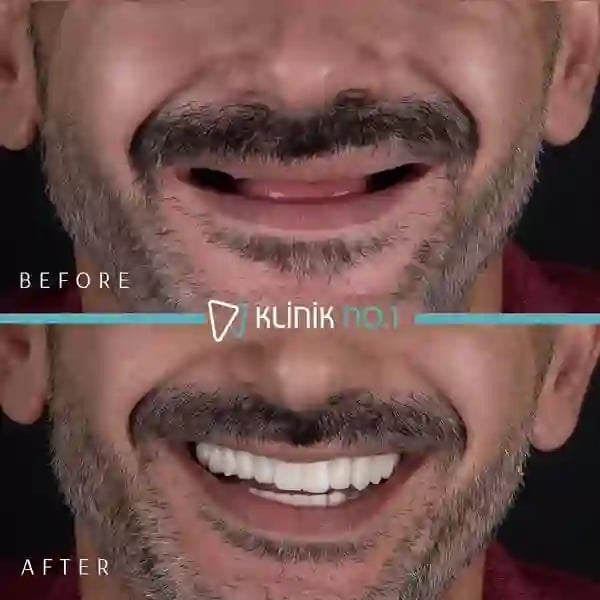 klinik-no1-before-after-4