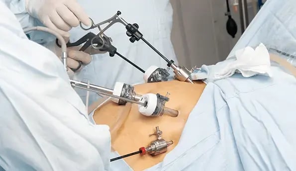 laporoscopic-sleeve-surgery