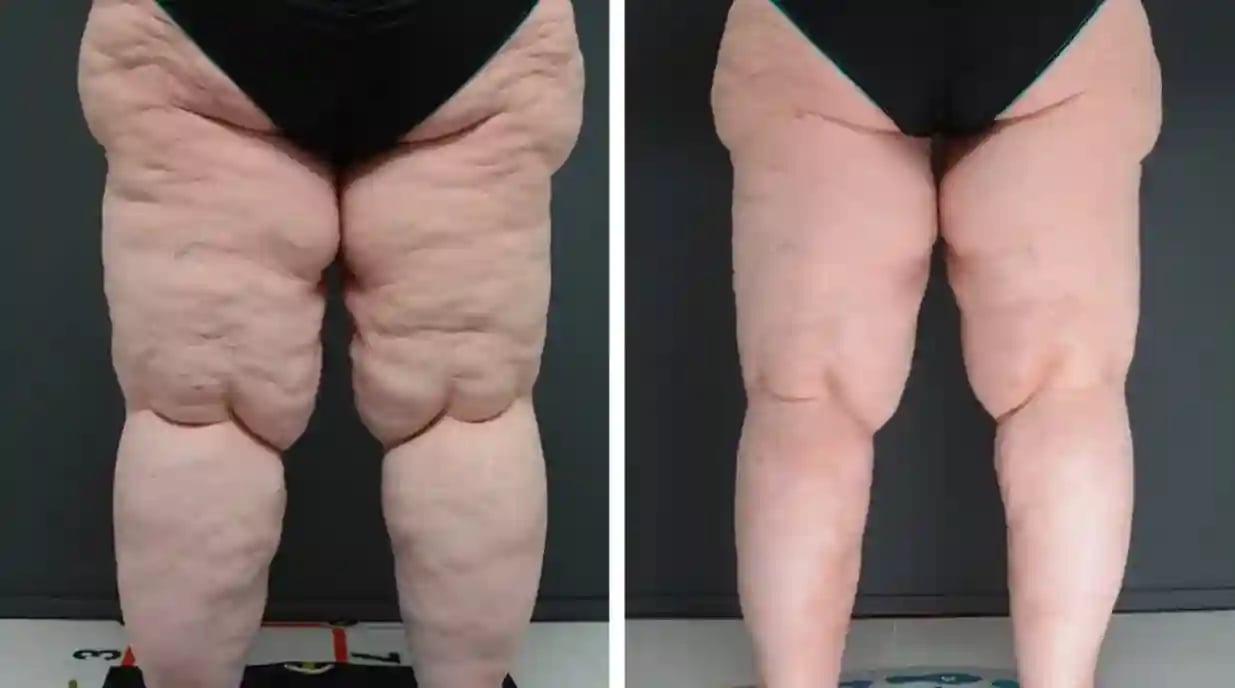 lipedema-1