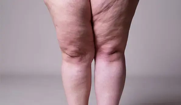 lipedema-cost-in-istanbul