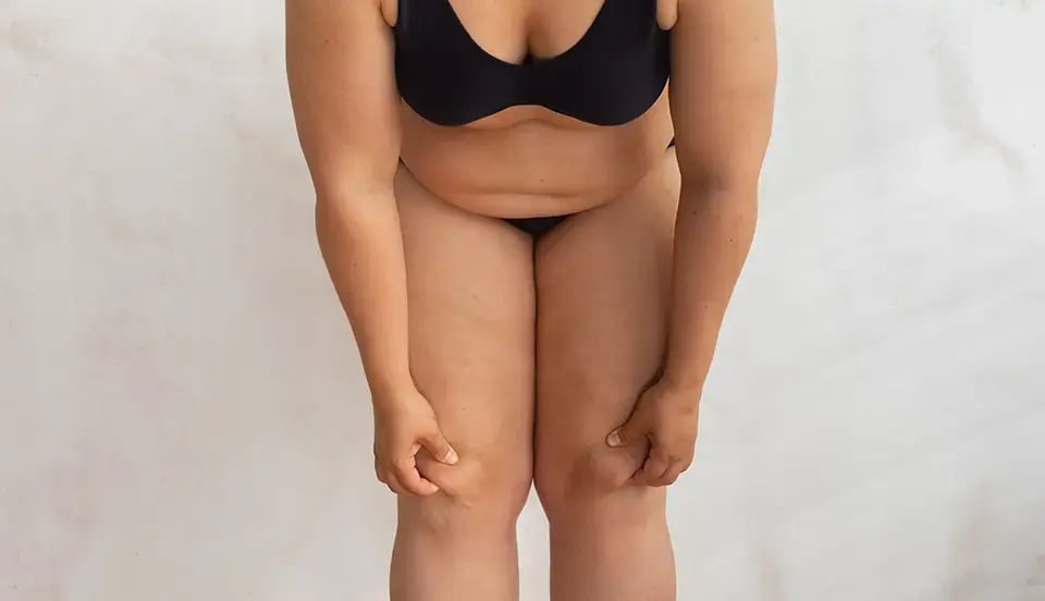 lipedema-leg-pain-problem-1