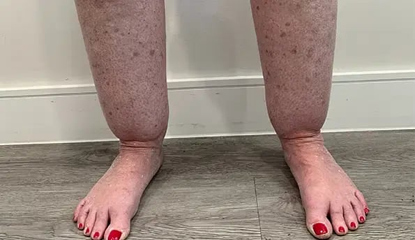 lipedema-legs-1