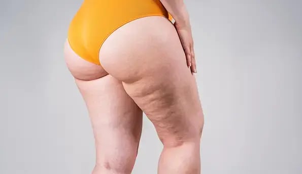 lipedema-legs