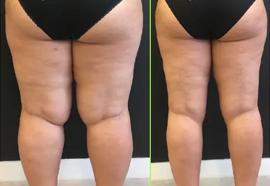 lipedema-treatment-before-after-kPH6yd6aLPmNZkfi