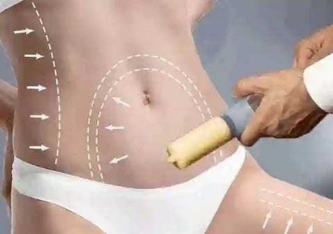 Liposuction