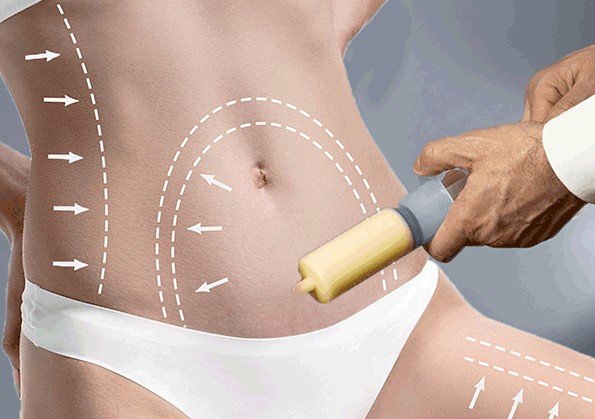 Liposuction: treatment areas marked on the tummy, hips and thigh