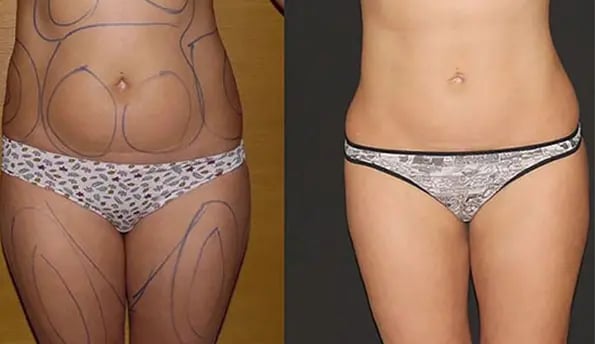liposuction-before-after