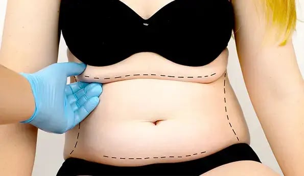 liposuction-cost (1)