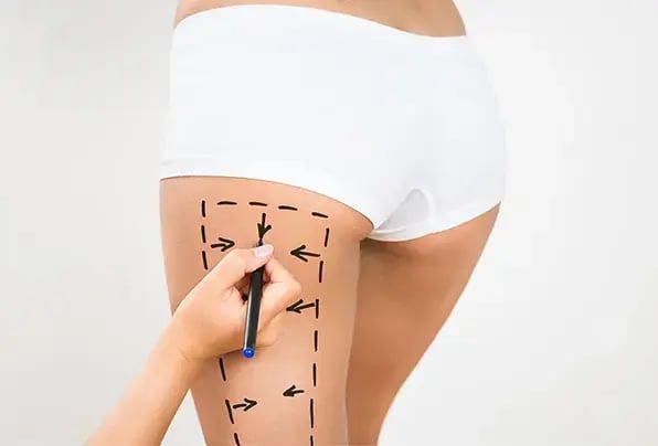 liposuction-for-leg