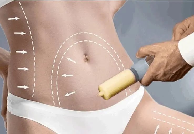 liposuction-min (1)