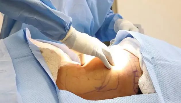 liposuction-surgery
