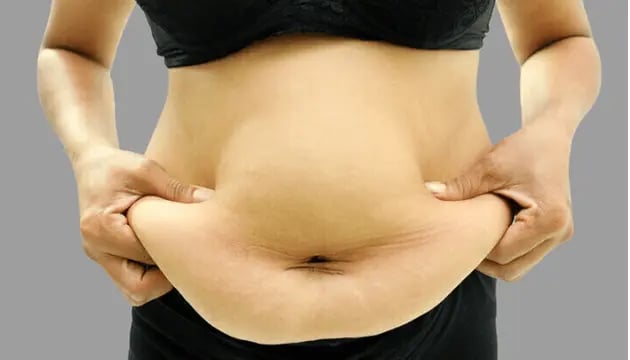 liposuction