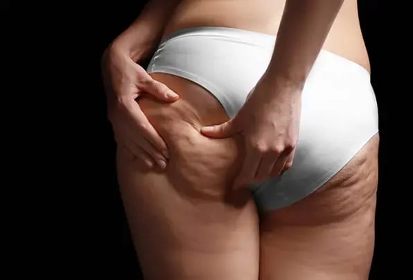 living-with-cellulite