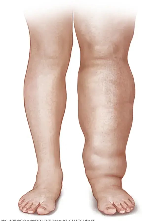 lymphedema