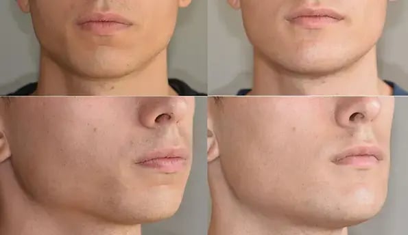 male-jawline-filler-before-after