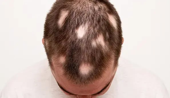 man-alopecia-areata