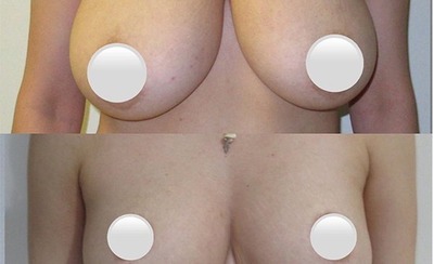 Before and after, Lipedema surgery, Dr. Reşat Aktaş
