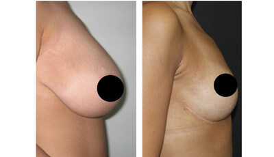 Before and after, Breast lift, Dr. Serhat Tuncer