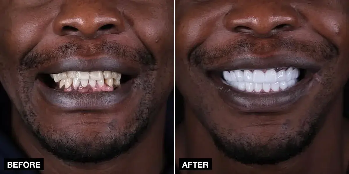 Before and after: 24 zirconia crowns, Klinik No.1, Istanbul