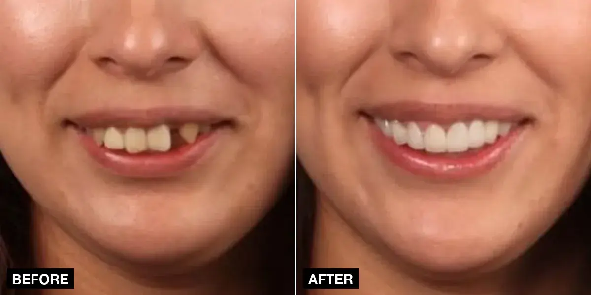 Before and after: 20 zirconia crowns, Klinik No.1, Istanbul