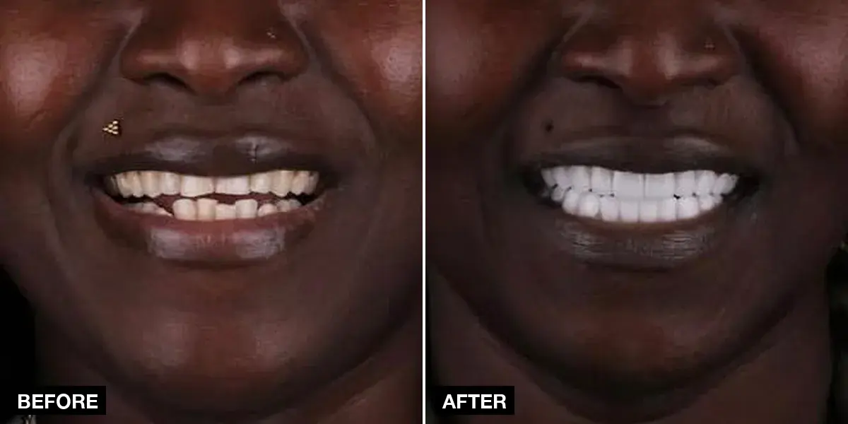 Before and after: 24 zirconia crowns, Klinik No.1, Istanbul