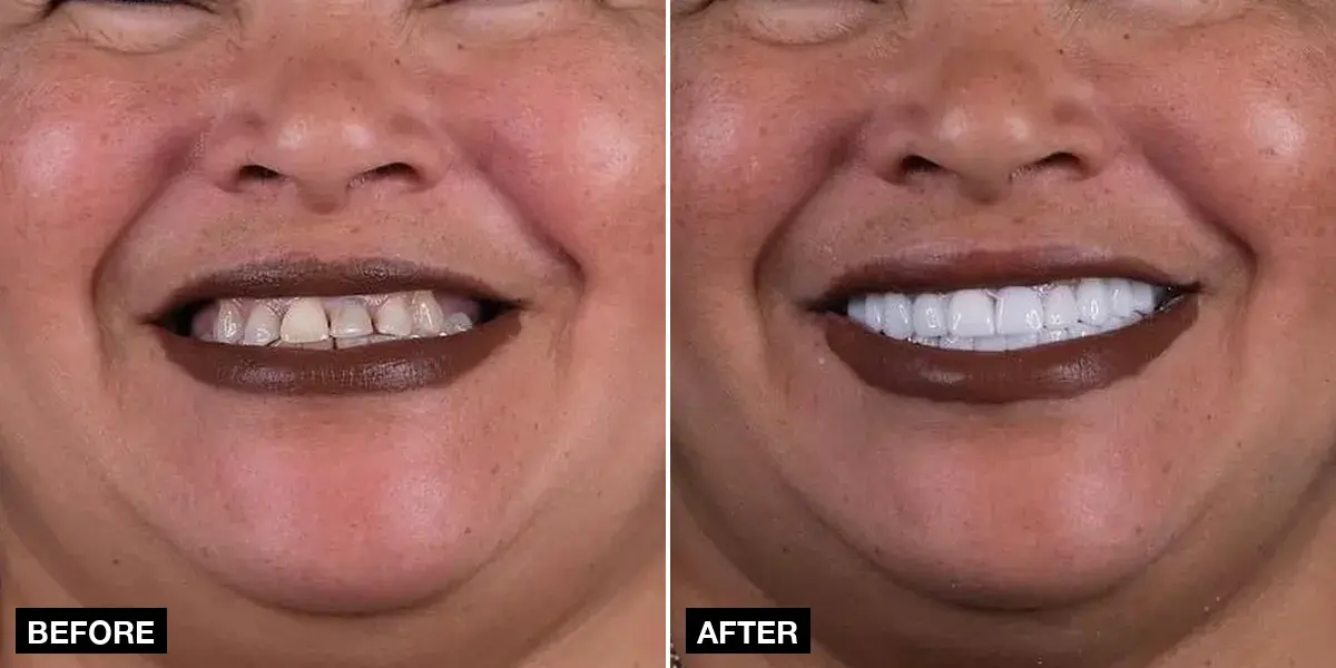 Before and after: 20 zirconia crowns, Klinik No.1, Istanbul