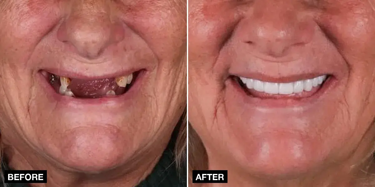 Before and after: Full-arch implants: 12 implants + 24 zirconia crowns, Klinik No.1, Istanbul