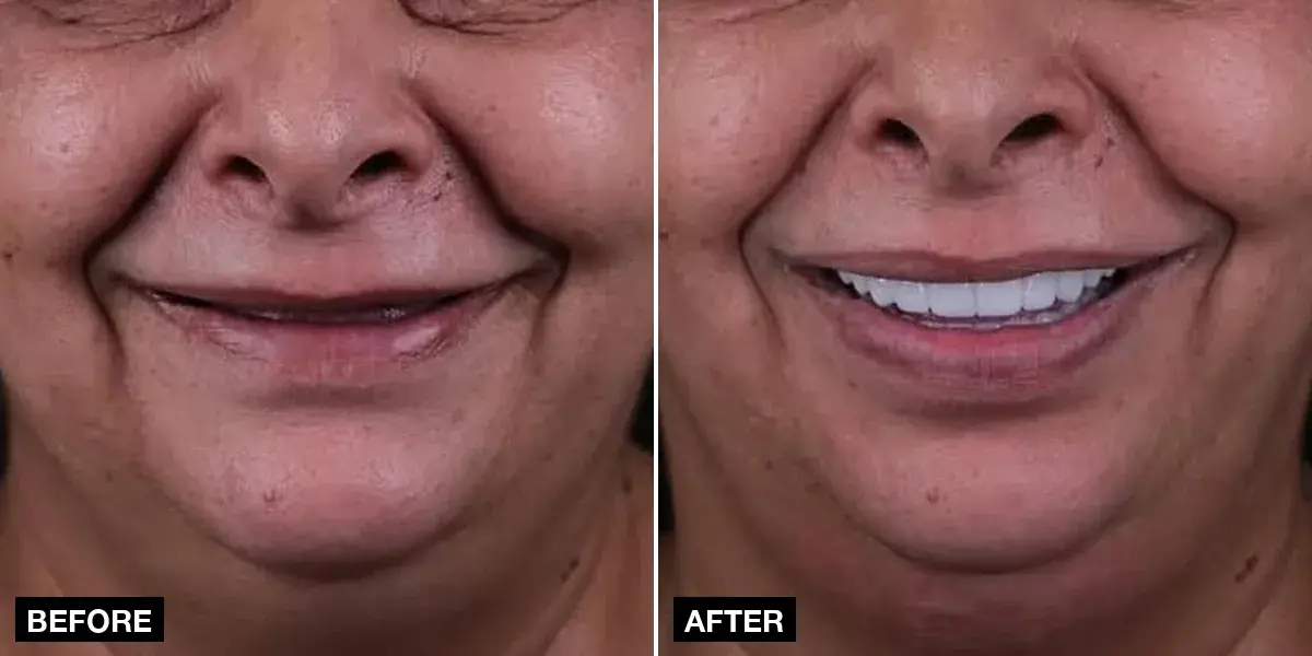 Before and after: Full-arch implants: 12 implants + 24 zirconia crowns, Klinik No.1, Istanbul