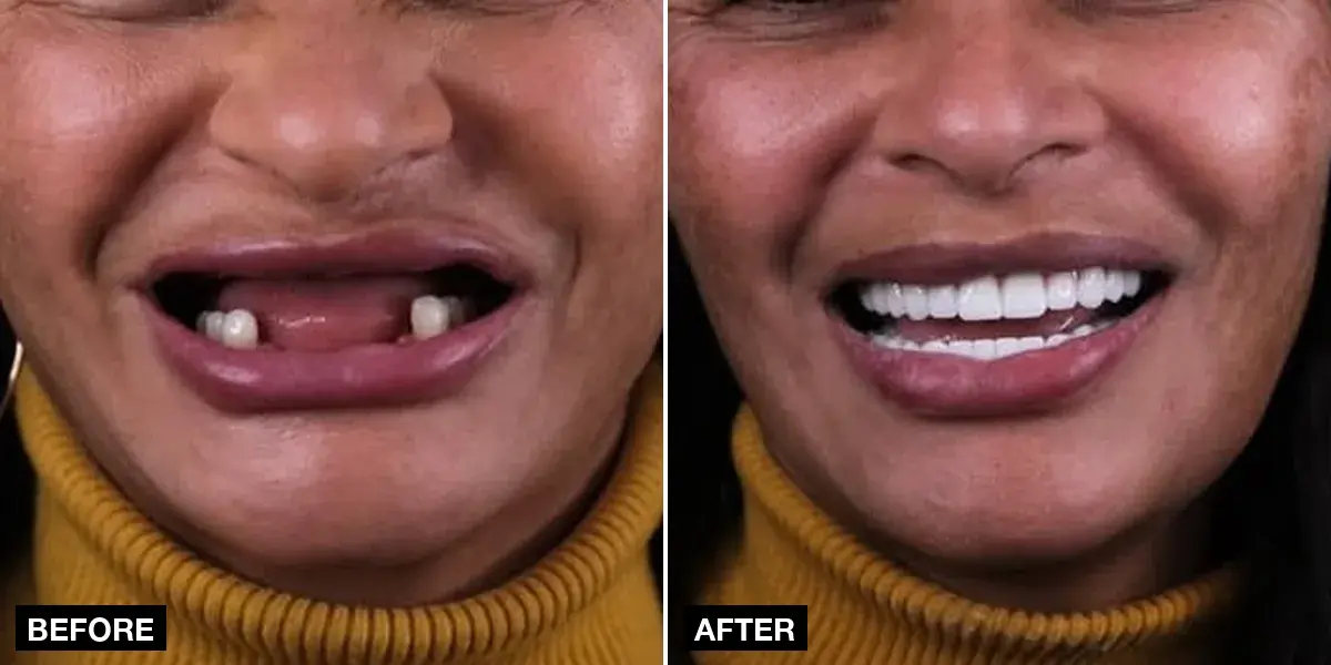 Before and after: Full-arch implants: 10 implants + 24 zirconia crowns, Klinik No.1, Istanbul