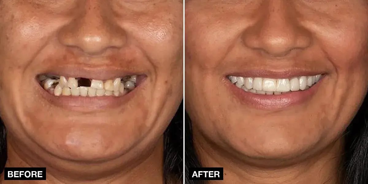 Before and after: 8 implants + 24 zirconia crowns, Klinik No.1, Istanbul